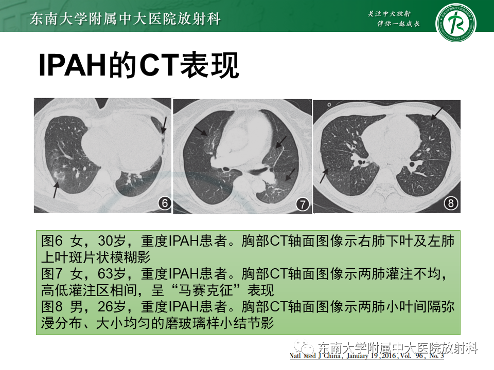 影像PPT - 【PPT】特发性肺动脉高压-22 影像PPT - 【PPT】特发性肺动脉高压-22
