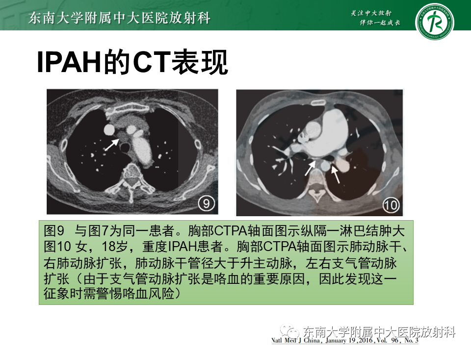 影像PPT - 【PPT】特发性肺动脉高压-23 影像PPT - 【PPT】特发性肺动脉高压-23