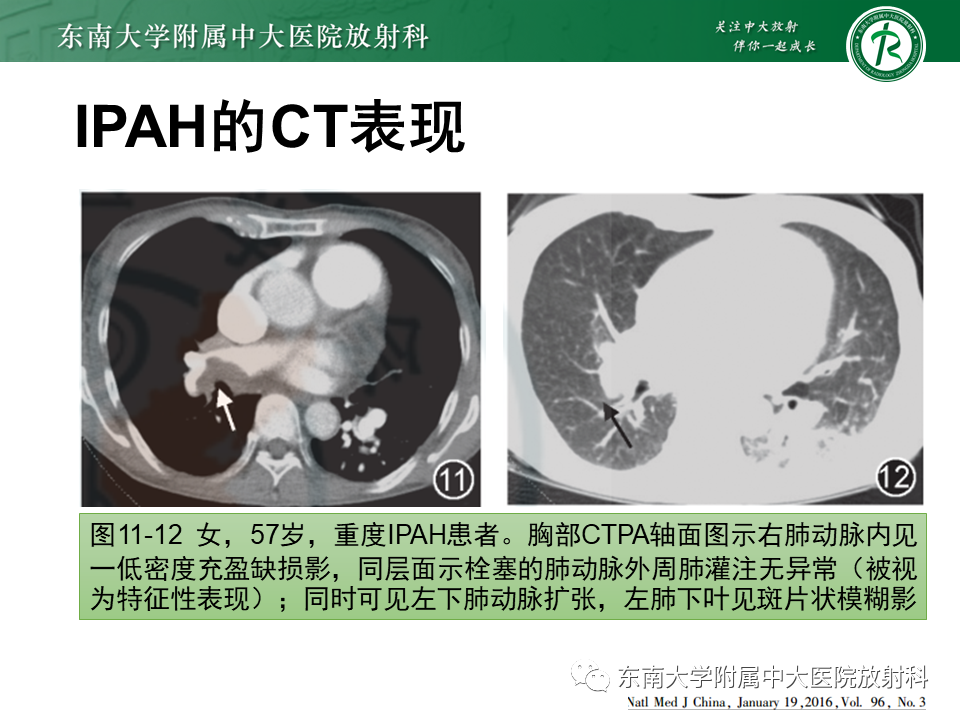影像PPT - 【PPT】特发性肺动脉高压-24 影像PPT - 【PPT】特发性肺动脉高压-24