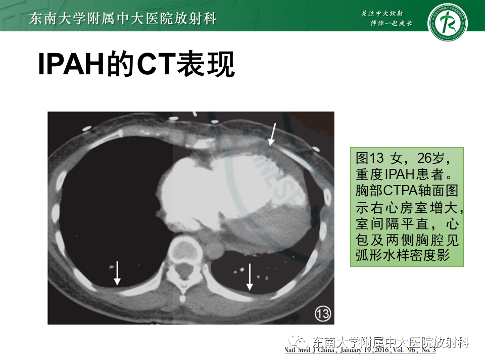 影像PPT - 【PPT】特发性肺动脉高压-25 影像PPT - 【PPT】特发性肺动脉高压-25