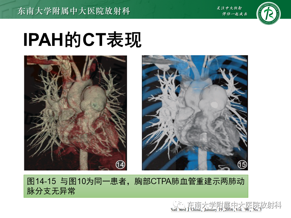 影像PPT - 【PPT】特发性肺动脉高压-26 影像PPT - 【PPT】特发性肺动脉高压-26