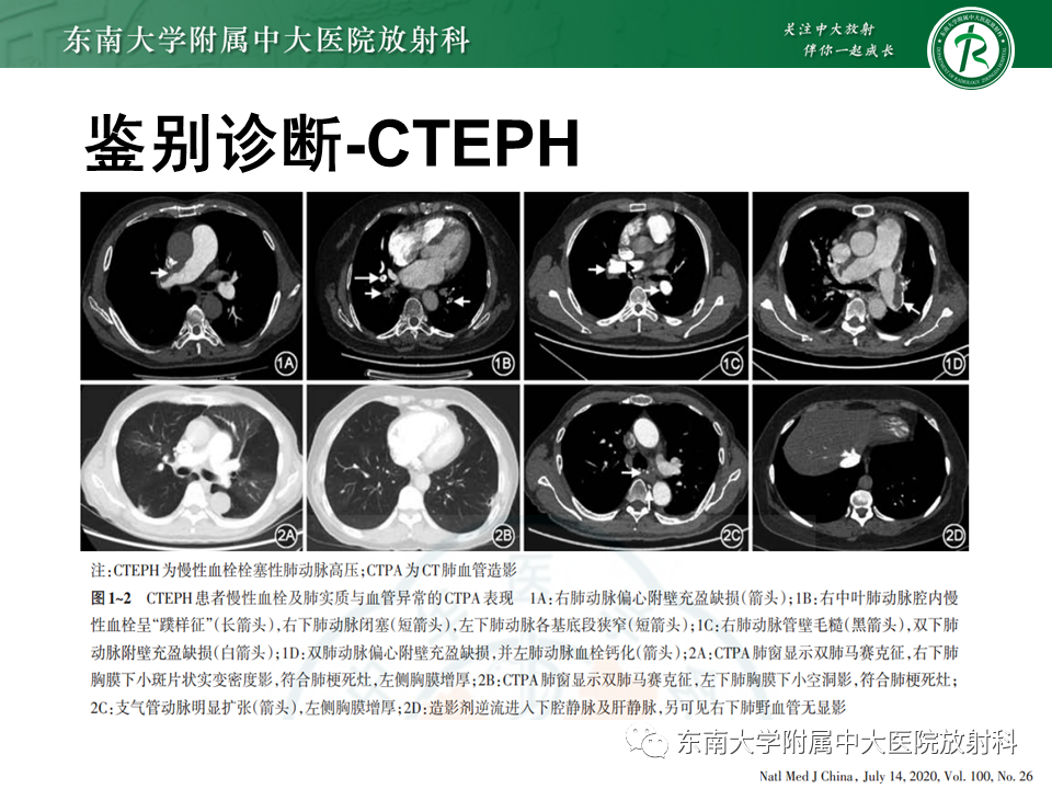 影像PPT - 【PPT】特发性肺动脉高压-31 影像PPT - 【PPT】特发性肺动脉高压-31