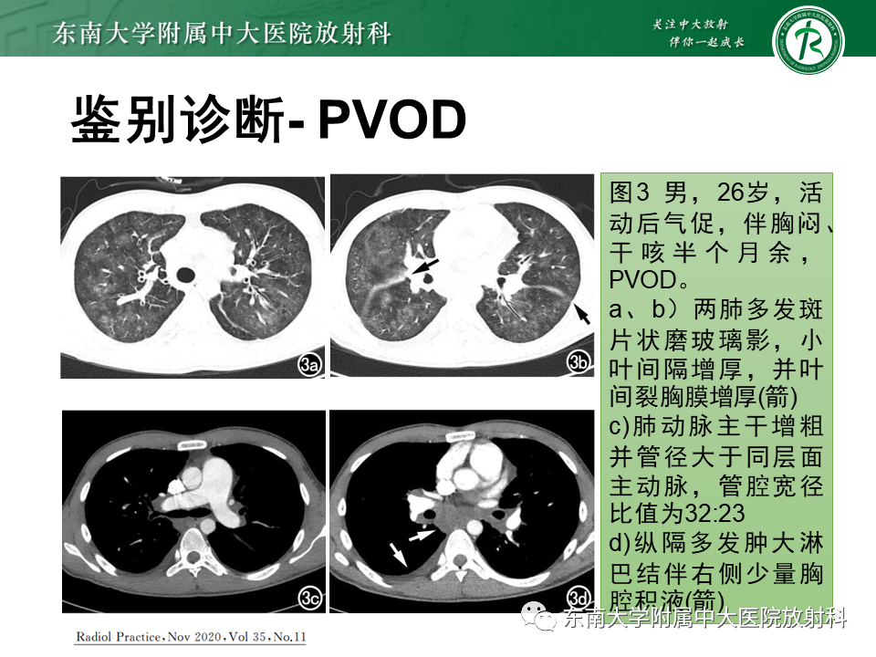 影像PPT - 【PPT】特发性肺动脉高压-36 影像PPT - 【PPT】特发性肺动脉高压-36
