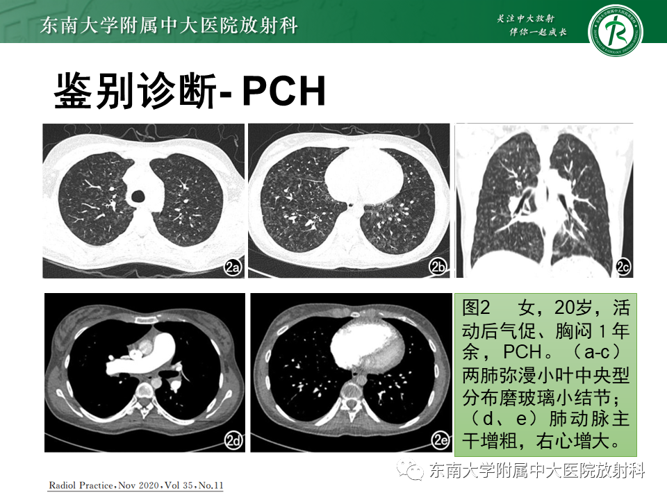 影像PPT - 【PPT】特发性肺动脉高压-35 影像PPT - 【PPT】特发性肺动脉高压-35