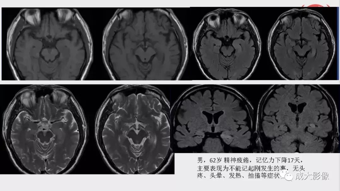 影像PPT - 【PPT】边缘叶脑炎-4