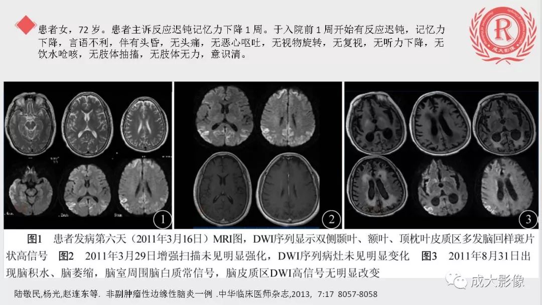 影像PPT - 【PPT】边缘叶脑炎-15