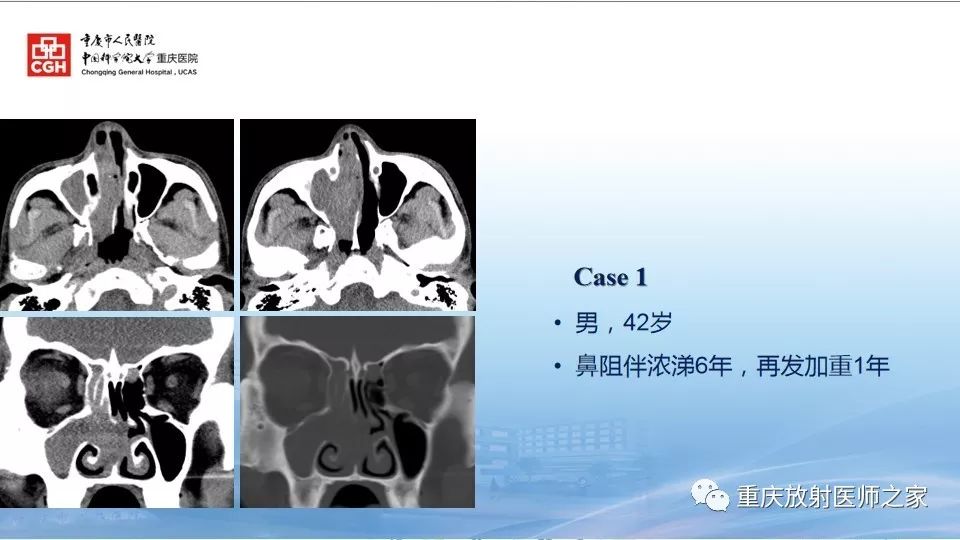 影像PPT - 【PPT】鼻腔鼻窦良性肿瘤及肿瘤样病变的影像诊断-9
