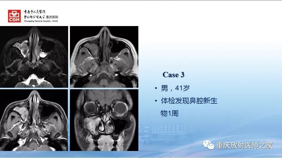 影像PPT - 【PPT】鼻腔鼻窦良性肿瘤及肿瘤样病变的影像诊断-12
