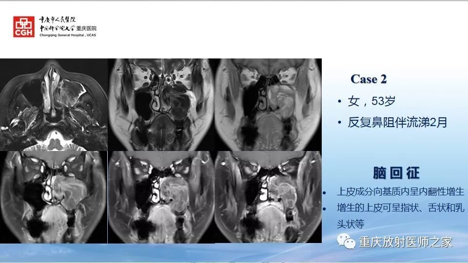 影像PPT - 【PPT】鼻腔鼻窦良性肿瘤及肿瘤样病变的影像诊断-11