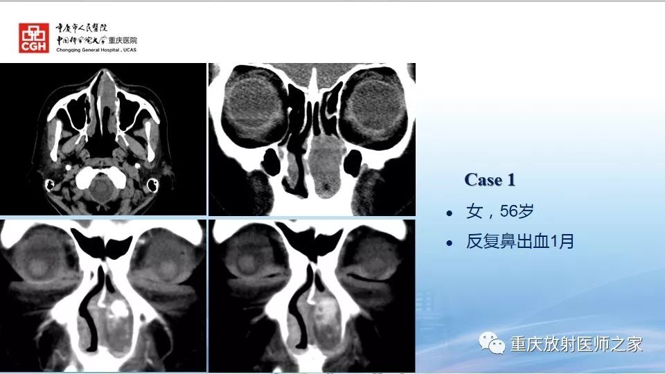 影像PPT - 【PPT】鼻腔鼻窦良性肿瘤及肿瘤样病变的影像诊断-14