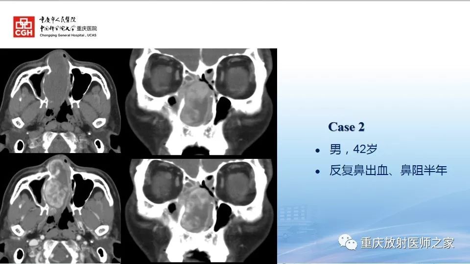 影像PPT - 【PPT】鼻腔鼻窦良性肿瘤及肿瘤样病变的影像诊断-15