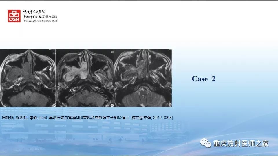 影像PPT - 【PPT】鼻腔鼻窦良性肿瘤及肿瘤样病变的影像诊断-18