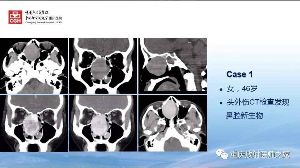 影像PPT - 【PPT】鼻腔鼻窦良性肿瘤及肿瘤样病变的影像诊断-20