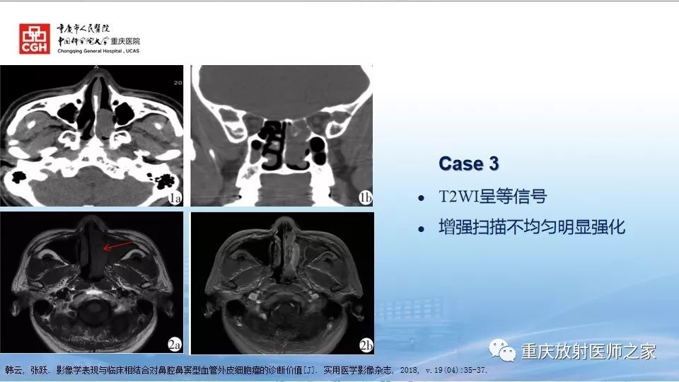 影像PPT - 【PPT】鼻腔鼻窦良性肿瘤及肿瘤样病变的影像诊断-25
