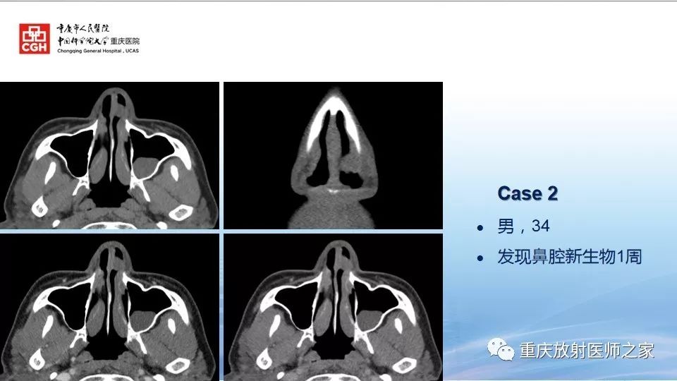 影像PPT - 【PPT】鼻腔鼻窦良性肿瘤及肿瘤样病变的影像诊断-32