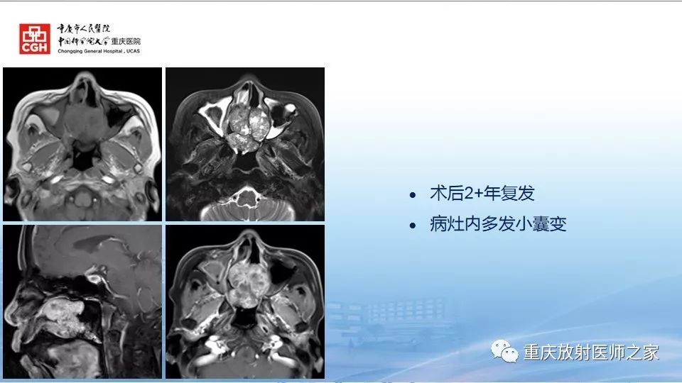 影像PPT - 【PPT】鼻腔鼻窦良性肿瘤及肿瘤样病变的影像诊断-29