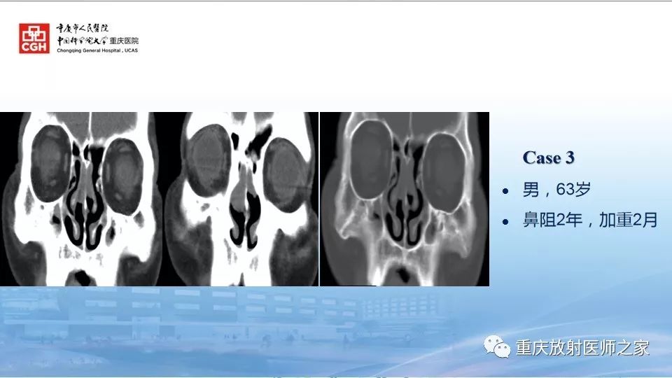 影像PPT - 【PPT】鼻腔鼻窦良性肿瘤及肿瘤样病变的影像诊断-36