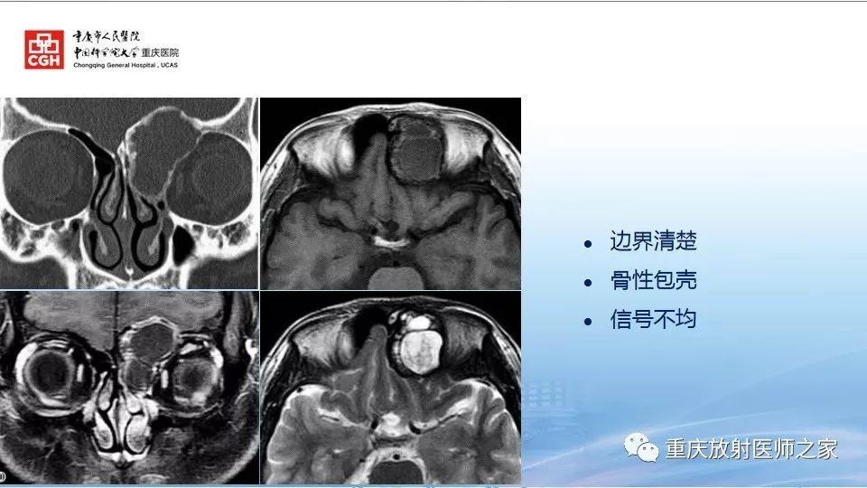 影像PPT - 【PPT】鼻腔鼻窦良性肿瘤及肿瘤样病变的影像诊断-38