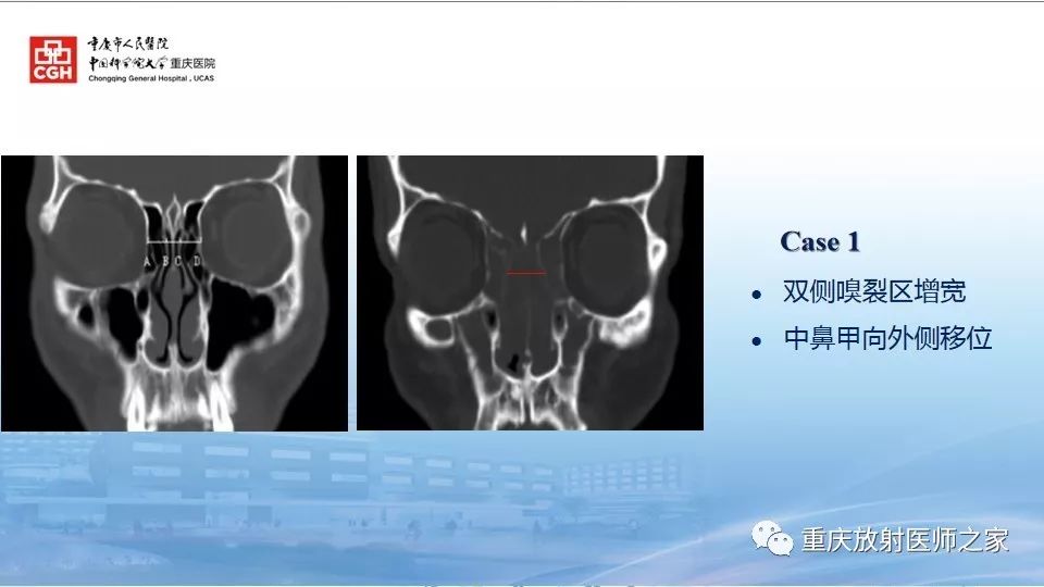 影像PPT - 【PPT】鼻腔鼻窦良性肿瘤及肿瘤样病变的影像诊断-34