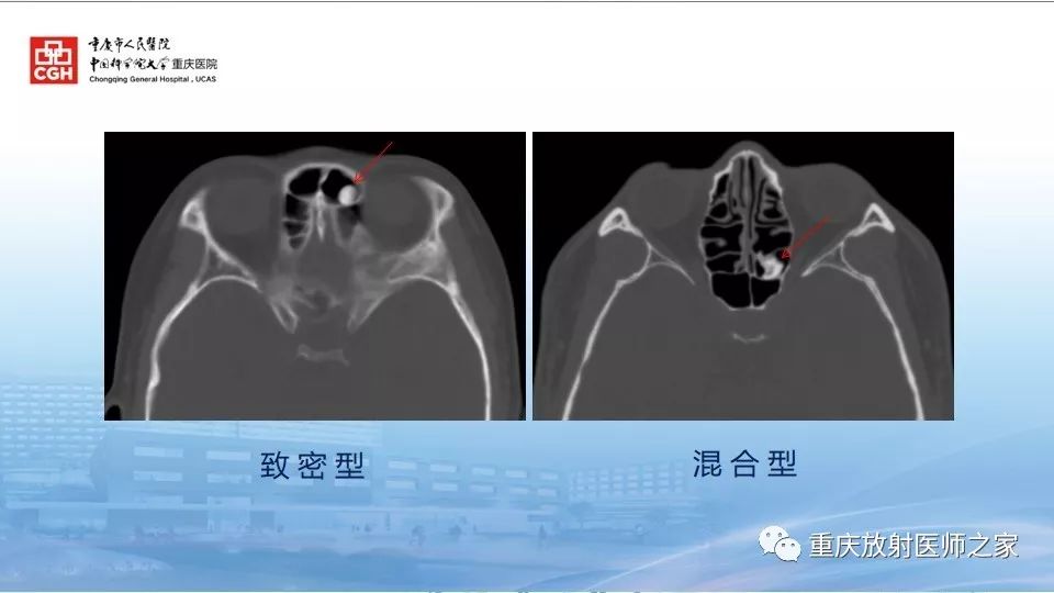 影像PPT - 【PPT】鼻腔鼻窦良性肿瘤及肿瘤样病变的影像诊断-40
