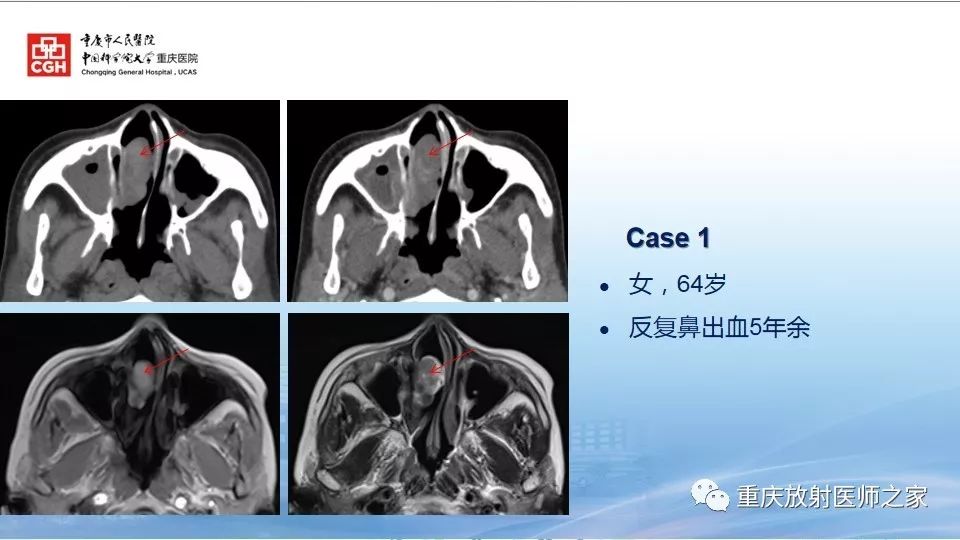 影像PPT - 【PPT】鼻腔鼻窦良性肿瘤及肿瘤样病变的影像诊断-44