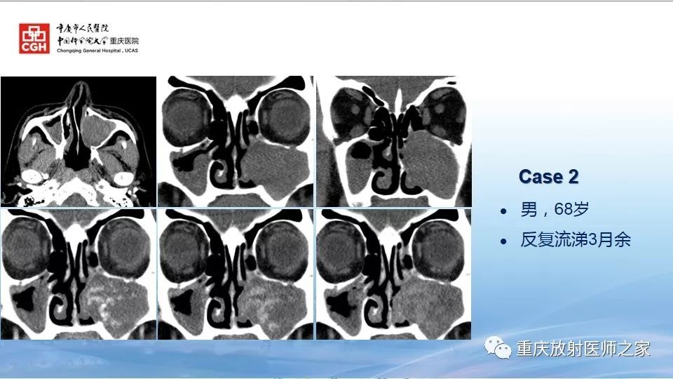 影像PPT - 【PPT】鼻腔鼻窦良性肿瘤及肿瘤样病变的影像诊断-47