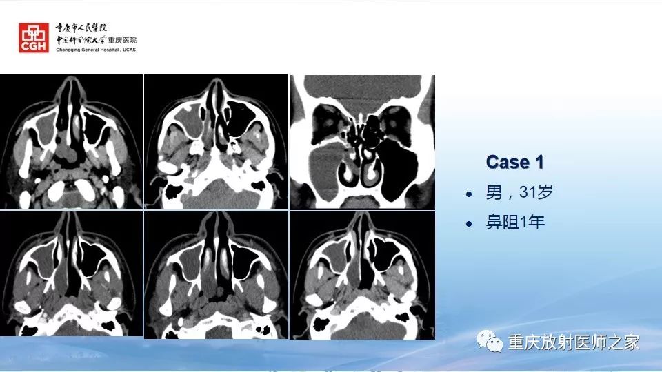 影像PPT - 【PPT】鼻腔鼻窦良性肿瘤及肿瘤样病变的影像诊断-50