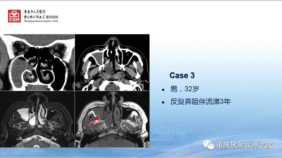 影像PPT - 【PPT】鼻腔鼻窦良性肿瘤及肿瘤样病变的影像诊断-52