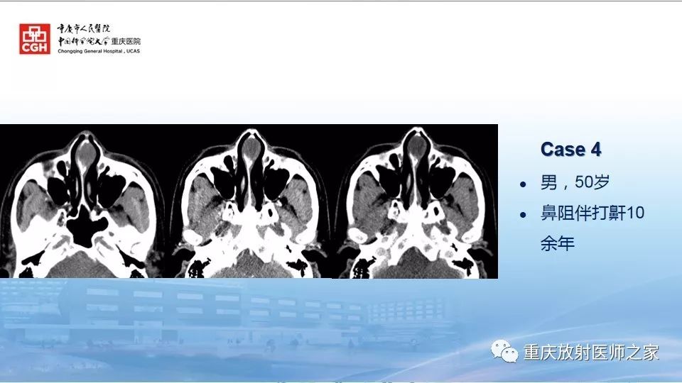 影像PPT - 【PPT】鼻腔鼻窦良性肿瘤及肿瘤样病变的影像诊断-53