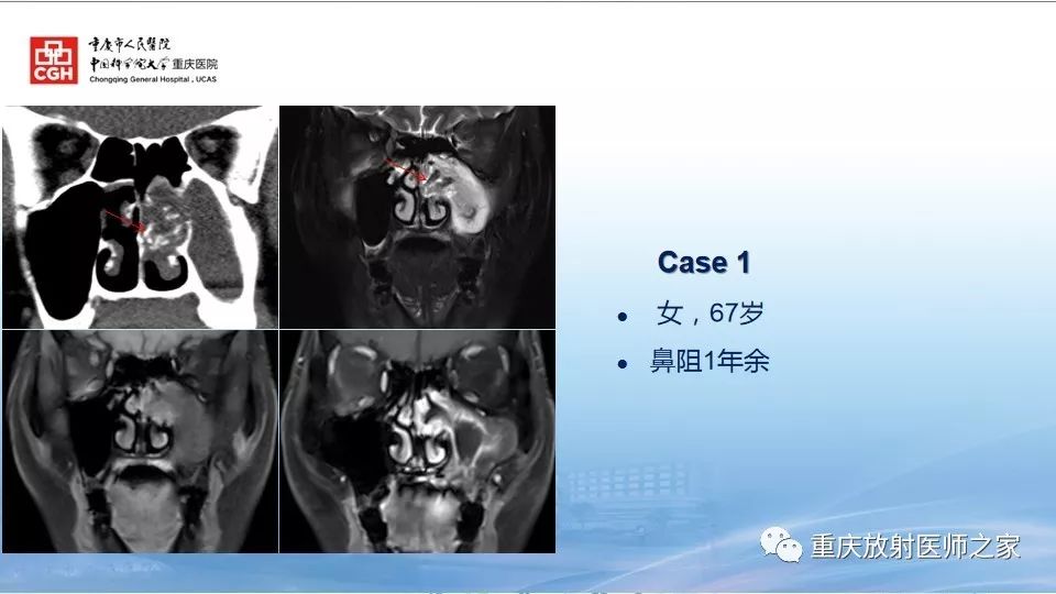 影像PPT - 【PPT】鼻腔鼻窦良性肿瘤及肿瘤样病变的影像诊断-55