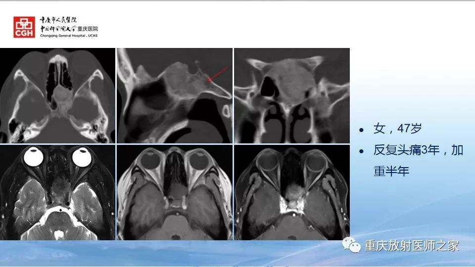 影像PPT - 【PPT】鼻腔鼻窦良性肿瘤及肿瘤样病变的影像诊断-60