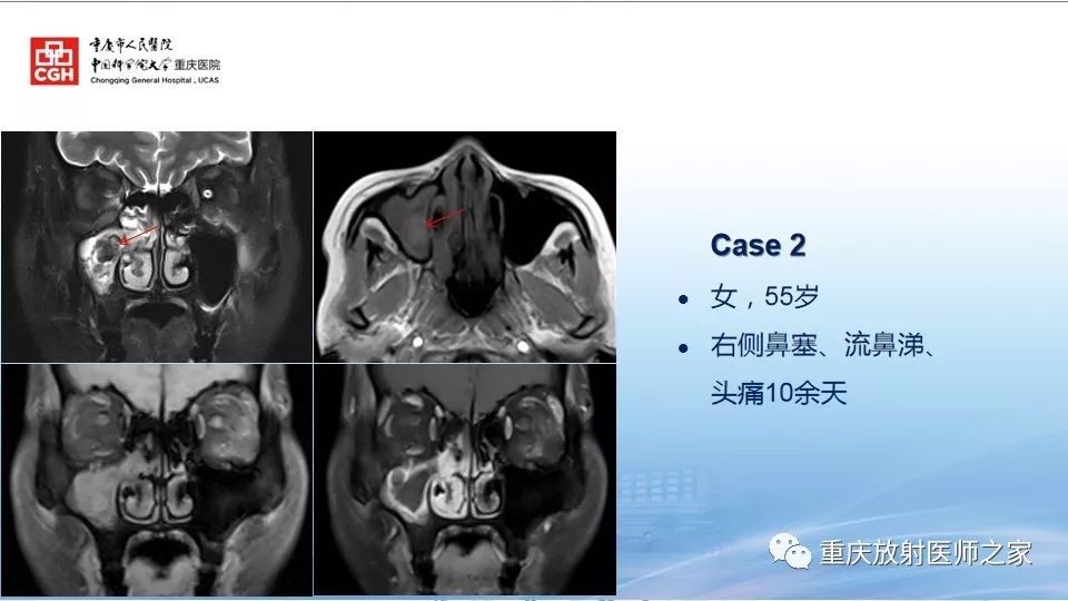 影像PPT - 【PPT】鼻腔鼻窦良性肿瘤及肿瘤样病变的影像诊断-56