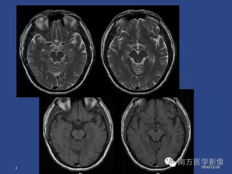 影像PPT - 【PPT】边缘叶脑炎（Limbic encephalitis，LE）-3