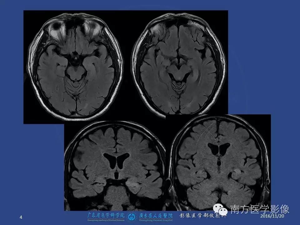 影像PPT - 【PPT】边缘叶脑炎（Limbic encephalitis，LE）-4