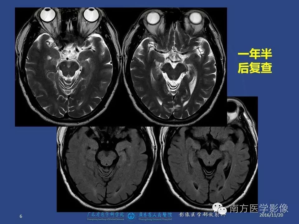 影像PPT - 【PPT】边缘叶脑炎（Limbic encephalitis，LE）-6