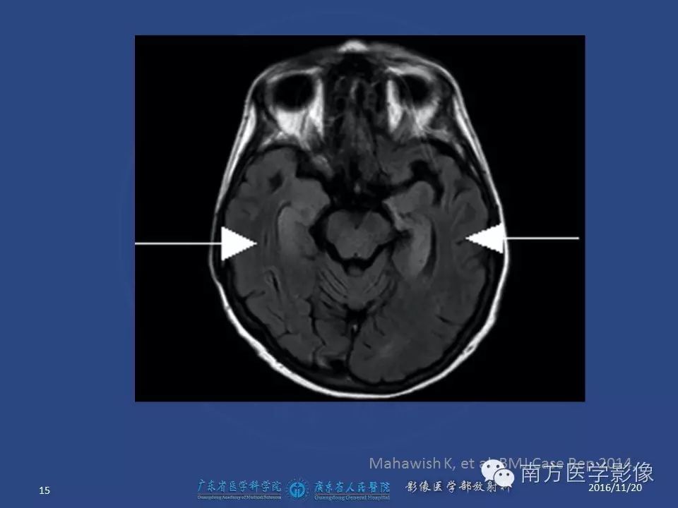 影像PPT - 【PPT】边缘叶脑炎（Limbic encephalitis，LE）-15