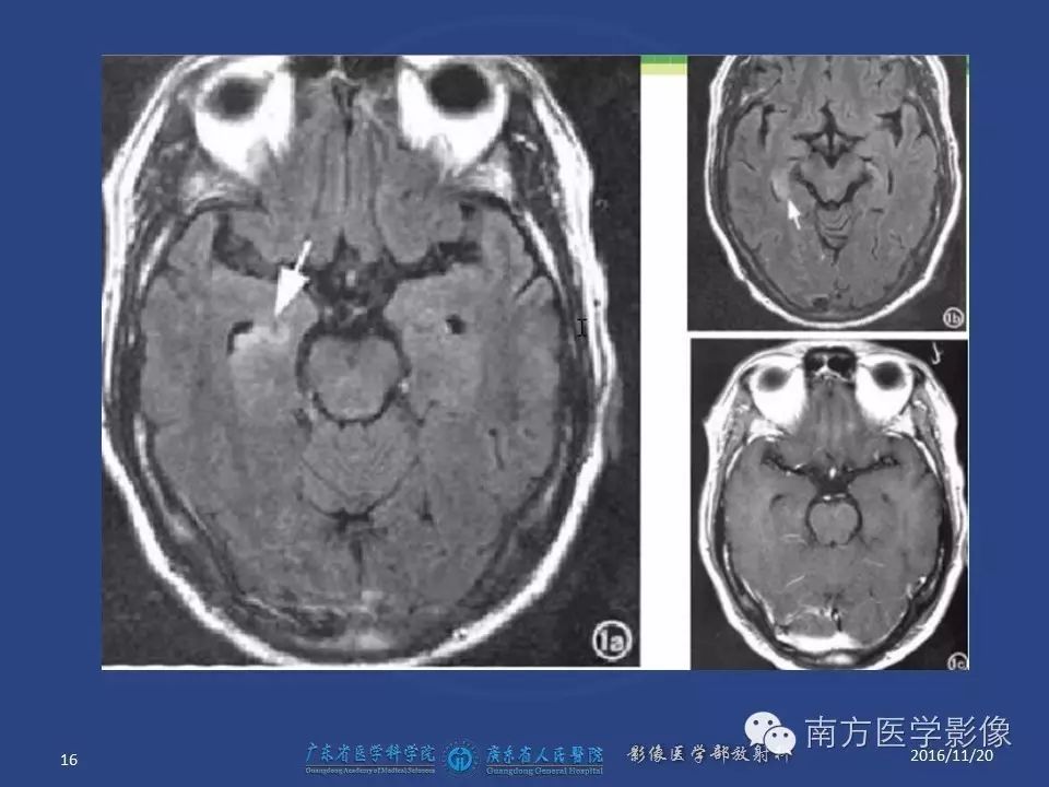 影像PPT - 【PPT】边缘叶脑炎（Limbic encephalitis，LE）-16