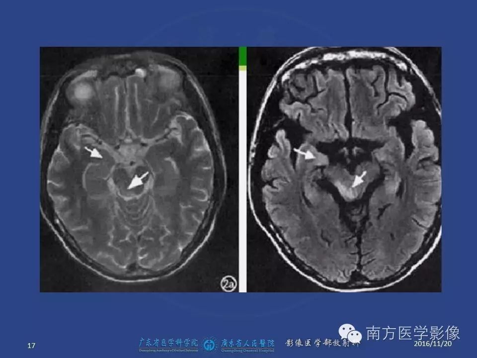 影像PPT - 【PPT】边缘叶脑炎（Limbic encephalitis，LE）-17