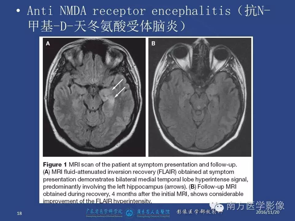 影像PPT - 【PPT】边缘叶脑炎（Limbic encephalitis，LE）-18