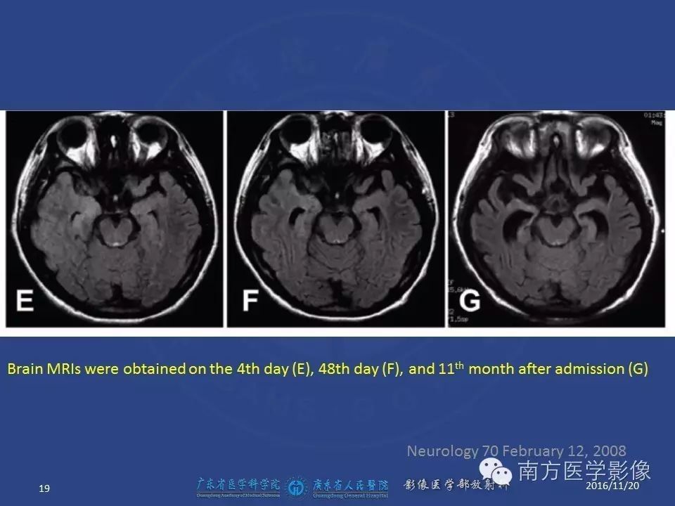 影像PPT - 【PPT】边缘叶脑炎（Limbic encephalitis，LE）-19