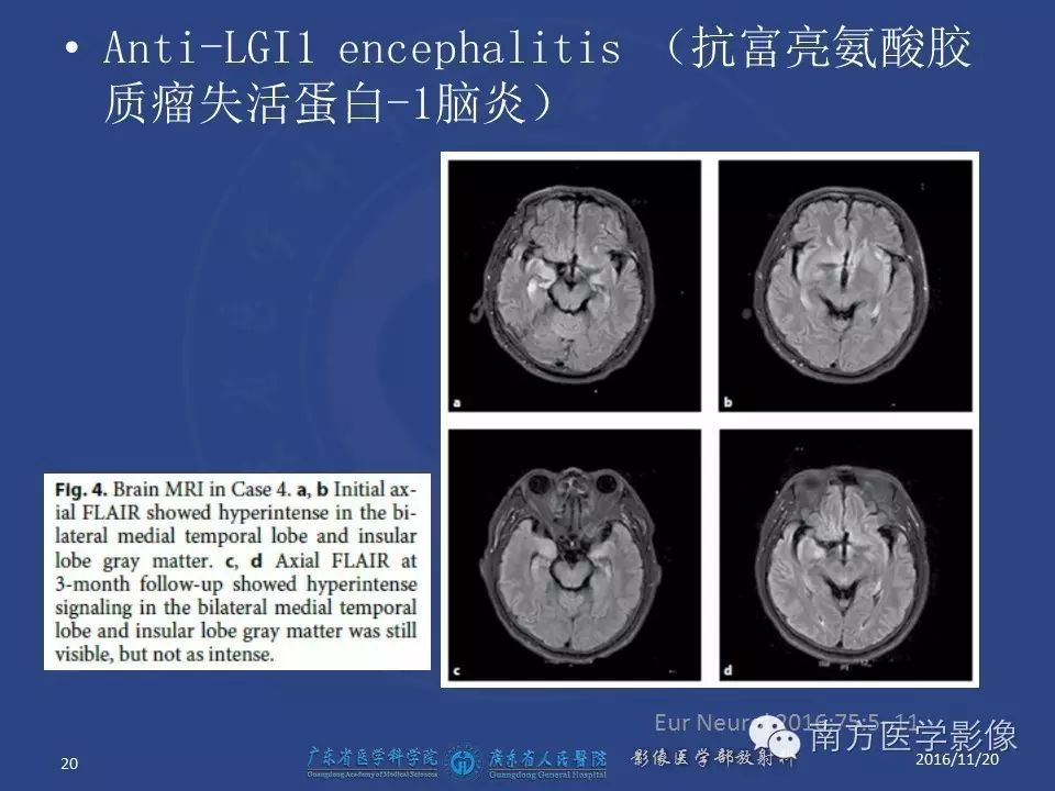 影像PPT - 【PPT】边缘叶脑炎（Limbic encephalitis，LE）-20