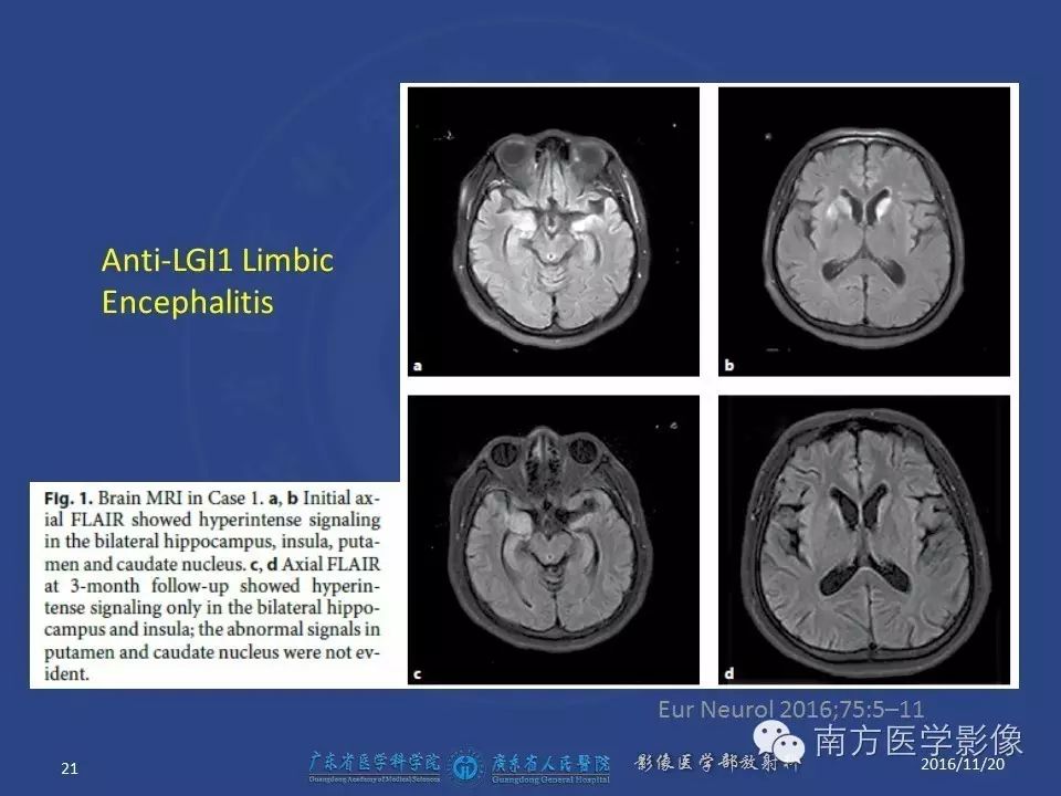 影像PPT - 【PPT】边缘叶脑炎（Limbic encephalitis，LE）-21