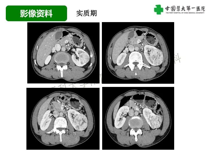 影像PPT - 【病例】肾脏嗜酸细胞腺瘤1例CT影像-5