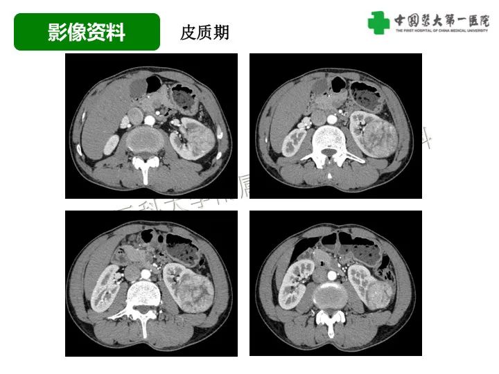 影像PPT - 【病例】肾脏嗜酸细胞腺瘤1例CT影像-4