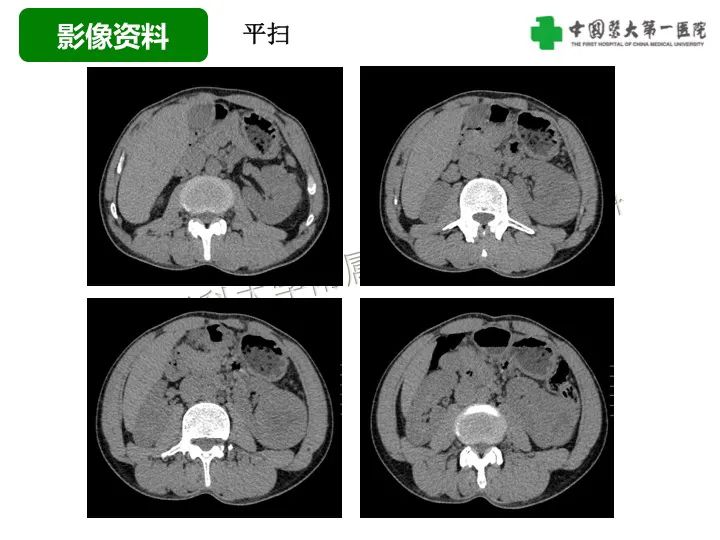 影像PPT - 【病例】肾脏嗜酸细胞腺瘤1例CT影像-3