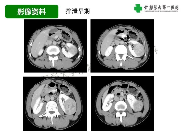 影像PPT - 【病例】肾脏嗜酸细胞腺瘤1例CT影像-6