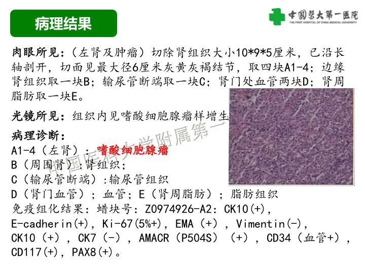 影像PPT - 【病例】肾脏嗜酸细胞腺瘤1例CT影像-8