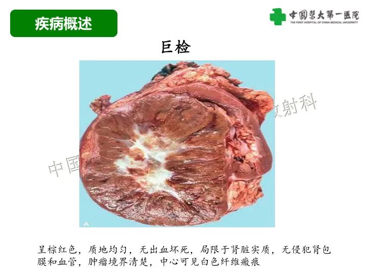 影像PPT - 【病例】肾脏嗜酸细胞腺瘤1例CT影像-12