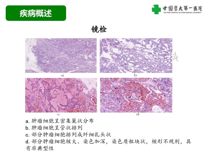 影像PPT - 【病例】肾脏嗜酸细胞腺瘤1例CT影像-13