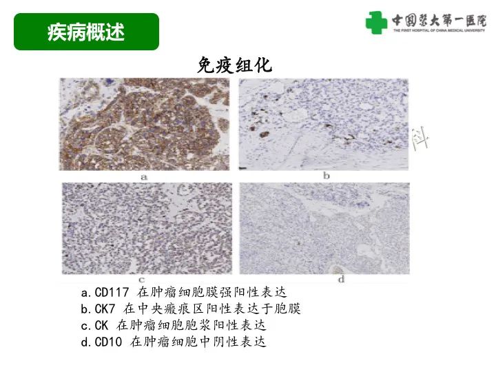 影像PPT - 【病例】肾脏嗜酸细胞腺瘤1例CT影像-14